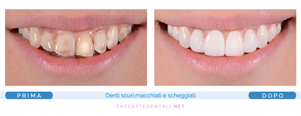 faccette dentali dentista torino trotta