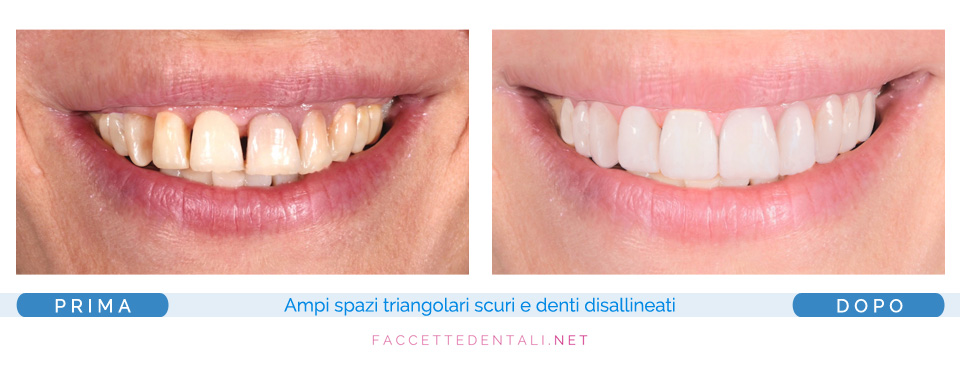 faccette dentali dentista torino trotta