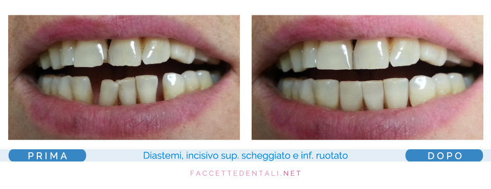 faccette dentali dentista torino trotta