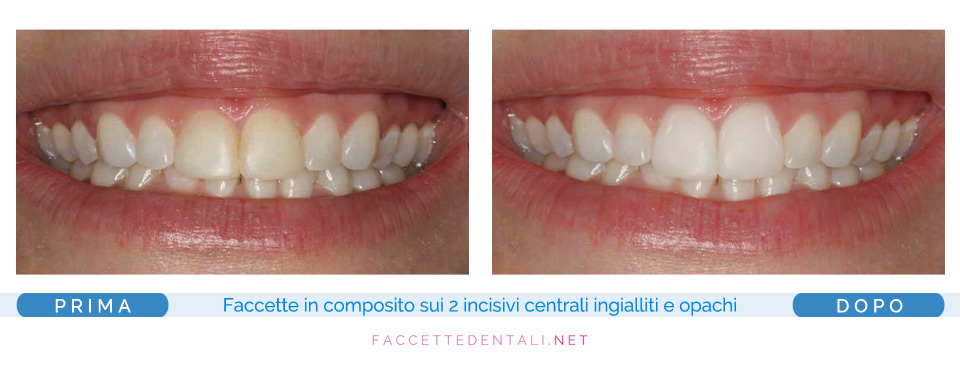 Faccette Dentali Torino